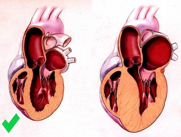 Cardione apsaugo nuo širdies skilvelių hipertrofijos